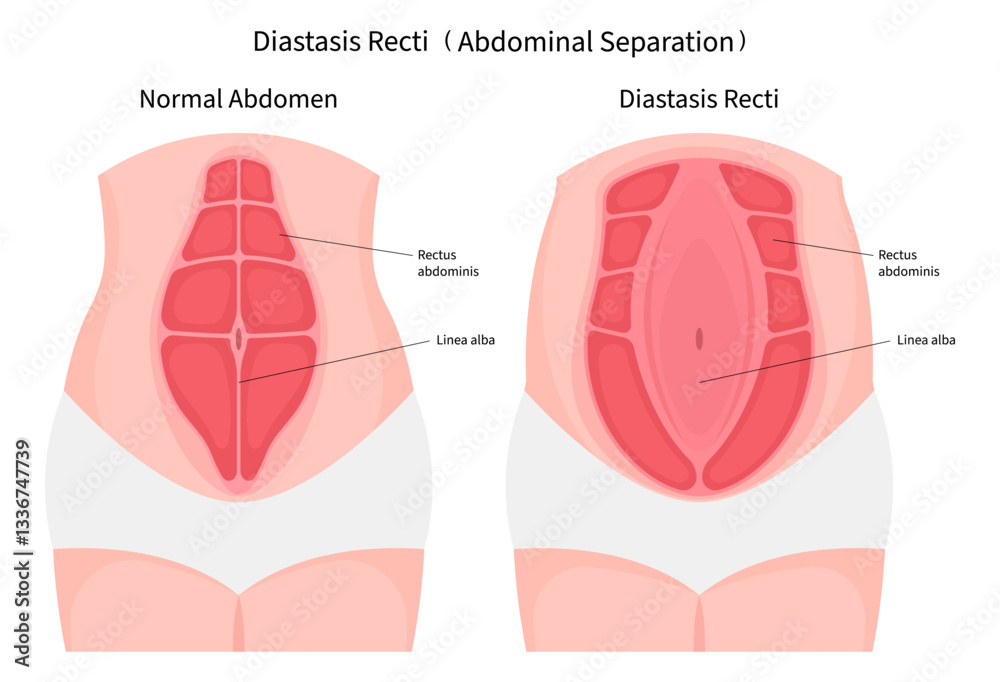Anatomy of abdominal muscle separation after surgical which in medical ...