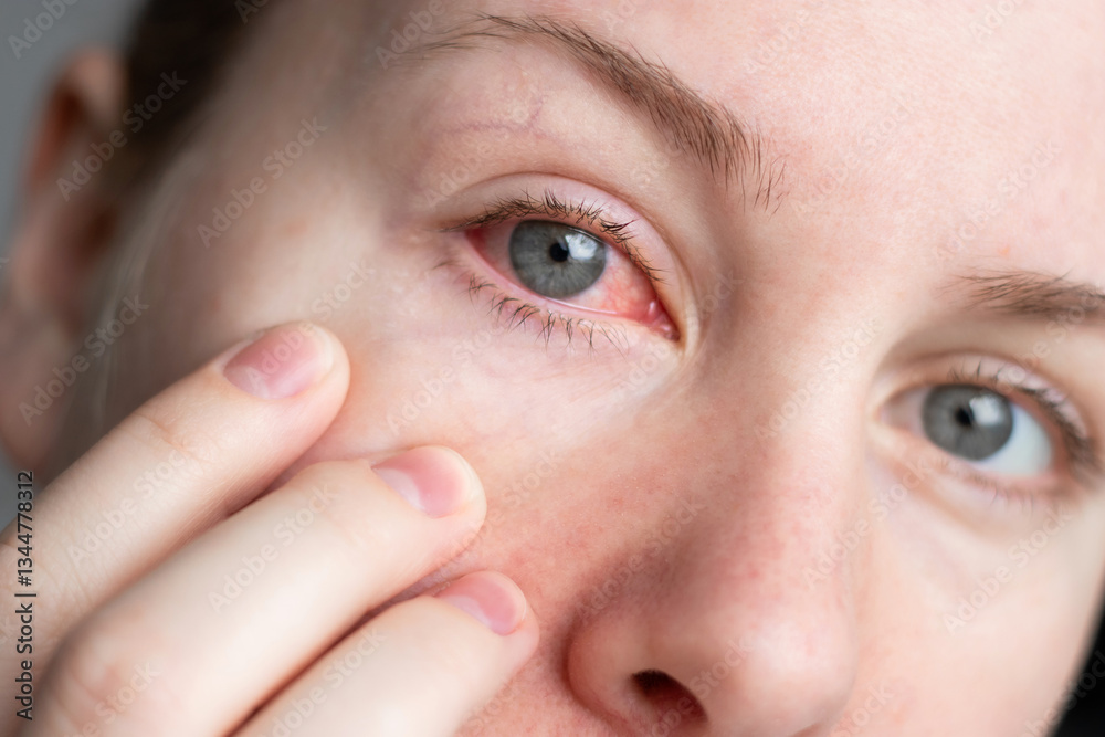 Close up of female face with one red eye suffering from infection ...