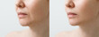 © Aleksandr Rybalko - Female nasolabial fold before and after wrinkle smoothing procedures. Correction of the chin and neck shape. The result of the rejuvenation procedure at the aesthetic medicine clinic.