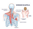 © VectorMine - Winged scapula diagram shows shoulder blade protrusion, highlighting muscles and nerves. Outline diagram