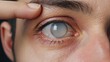 © aznan - Man with cataract in his eye