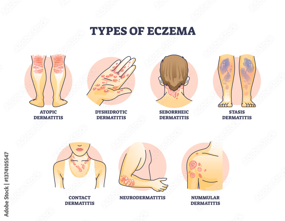 Eczema types diagram shows atopic, dyshidrotic, and seborrheic ...