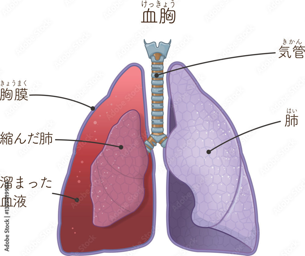 肺・気管・気胸・血胸・血気胸のイラスト lungs,windpipe,hemothorax,pneumothorax ...