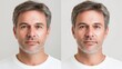 © Elmin - Man before and after plastic surgery on white background