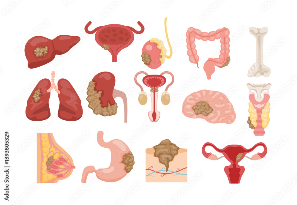 Different types of common cancer, educational medical poster design ...