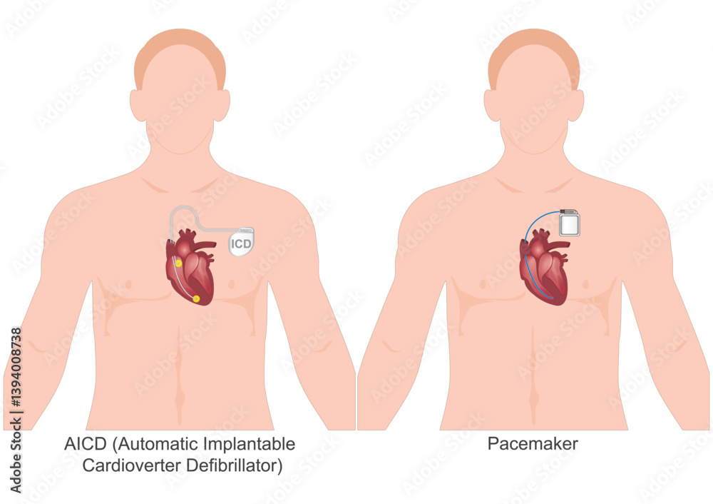 Icd Pacemaker Types The difference between pacemakers and ICDs. Stock Vector | Adobe Stock