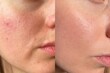 © Vikto - Comparison image of a female face before and after skincare. Visible improvement in pore appearance, acne reduction, and skin glow. Ideal for beauty and dermatology concepts.