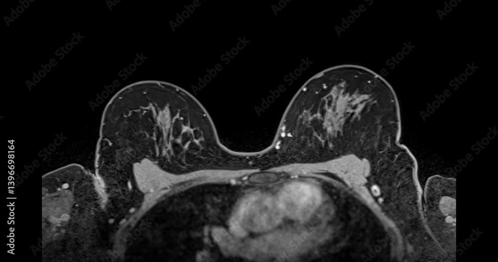MRI scan of the breasts in an axial view with contrast enhancement ...