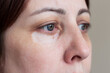 © Ольга Шефер - Close-up of young caucasian woman's face with big pigment spot on the skin under eye. Cosmetology. Vitiligo skin