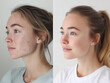 ©  Mariya Primakina - Before and after acne treatment of a young woman on a neutral background.