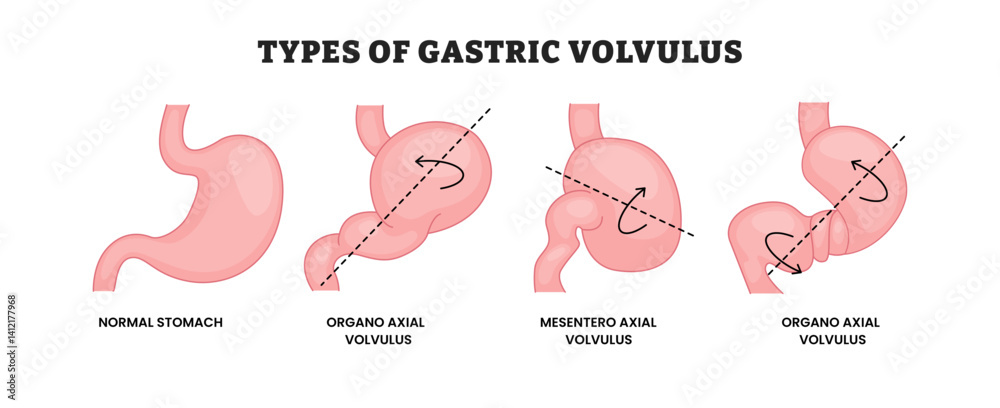 Different Types Of Gastric Volvulus Types Educational Medical Poster different-types-of-gastric-volvulus-types-educational-medical-poster