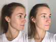©  Mariya Primakina - Before and after acne treatment of a young woman on a neutral background.