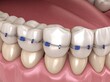 © Georgy - The illustration depicts an impacted cuspid with elastic for correction, presented in a medically accurate 3D dental representation