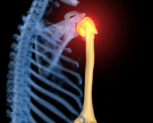 Poster - CT scan 3D rendering of  Arm or Humerus bone showing fracture head of humerus .
