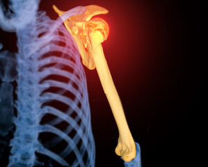 Poster - CT scan 3D rendering of  Arm or Humerus bone showing fracture head of humerus .