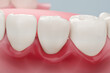 © piyaset - Receding Gums from Gingivitis and Periodontitis