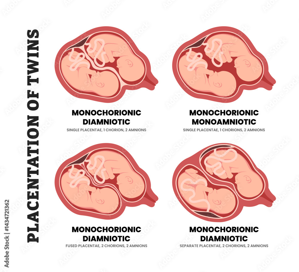 Different types of twin pregnancy or twin placentation types ...