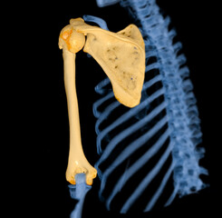 Poster - CT scan 3D rendering of  Arm or Humerus bone showing fracture head of humerus .
