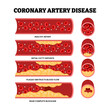 © Yumagema - Different types of coronary artery disease types as a chest heart problem, educational medical poster design healthcare scheme, labeled initial fatty deposits, plaque obstruction blood flow blockage.