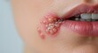 © phj.domingos - Detailed view of a mouth affected by herpes simplex, showing blisters and skin irritation.