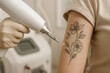 © Aleksandra - Laser tattoo removal in progress on womans arm with floral design