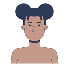 Poster - Black woman face with severe acne 2D vector illustration. Pimples, rosacea, pustules. African american female facial skin breakout flat character isolated on white background. Colorful cartoon image