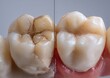 © Photique - Comparison of a decayed tooth and a healthy tooth.