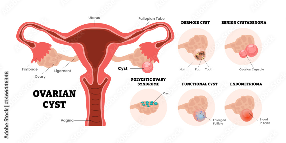 Different types of ovarian cyst types set collection, female ...
