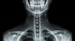 © Stanly - Comprehensive Lateral Spine X-ray This X-ray provides a detailed view of the spinal column with annotations for educational purposes and pathology identification.