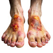 © Momna - Severe Foot Burns: Treatment & Symptoms
