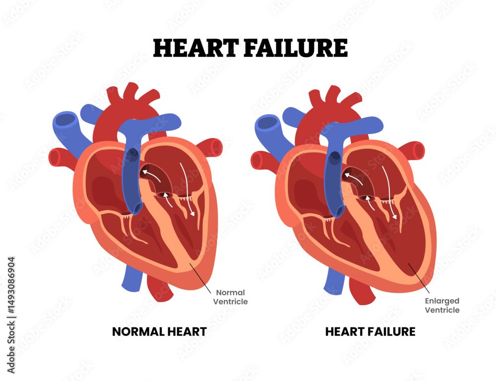 Стоковое векторное изображение «Heart failure, educational medical ...