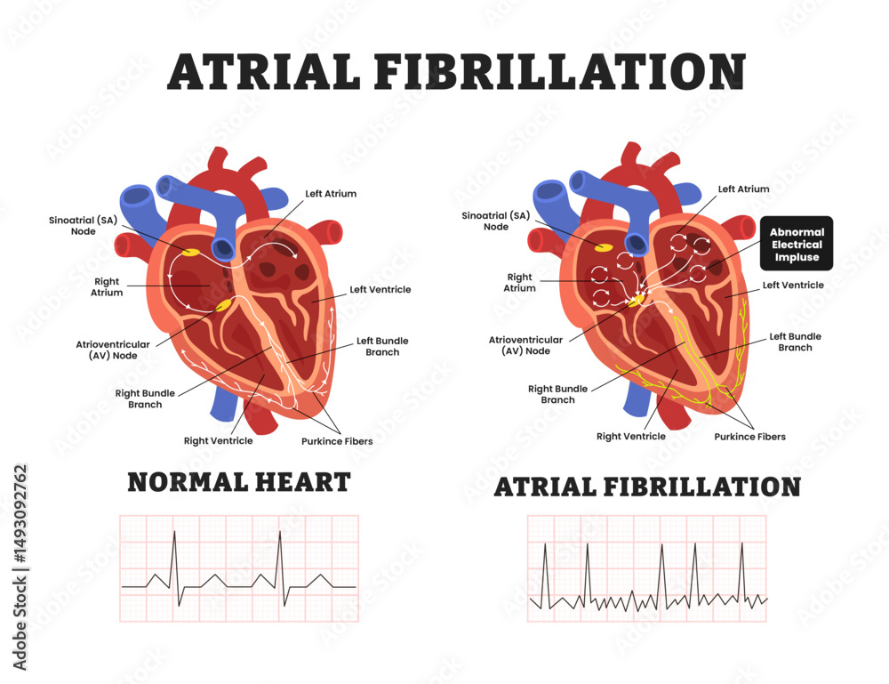 Heart atrial fibrillation vs Normal Heart, educational medical poster ...