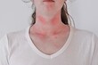 © Tunatura - Allergic skin reaction on the female neck and face