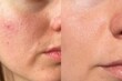 © Vikto - Close-up comparison of female cheek skin before and after acne treatment. Visible pore refinement, redness reduction, and smoother complexion. Skincare result concept.