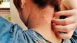 © Rung Kh - Portrait the fingers scratching the rash hives allergy and inflammation skin, reaction and urticaria, scar and atopic on the neck of the woman, health care and medical concept.