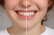 © Marcos Kulenkampff - A comparison of teeth showcasing the effect of whitening treatments, offering a bright smile.
