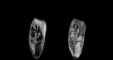 Poster - MRI foot scan for a diagnostic of the foot and ankle following symptoms: pain  both feet, swelling, redness or warmth, numbness or tingling and stiffness.