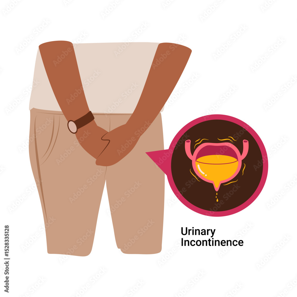 เวกเตอร์ Stock Man having Urinary Incontinence. Overactive bladder ...