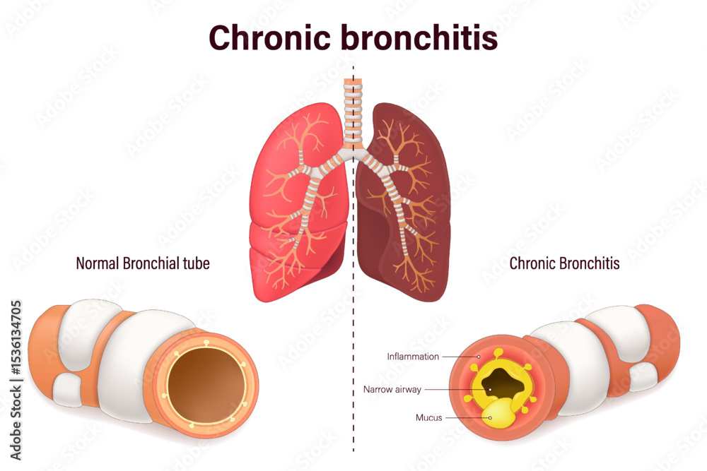 Bronchit Chronic bronchitis. Comparison between normal bronchial tube and ...