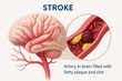 © Moonroad - Stroke brain artery clot plaque blood vessel medical illustration health disease anatomy blockage human organ neurology risk emergency infarction cerebral danger