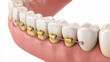 © MP-AI - Close-up of lower teeth with gold-colored braces attached, demonstrating orthodontic dental treatment for teeth alignment.