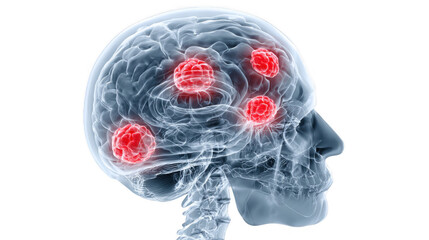 Poster - parkinson's disease impacting nerve cells in the brain, causing tremors highlighted in red, affectin