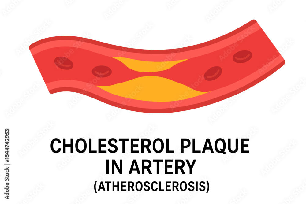Illustration of cholesterol plaque buildup in an artery, known as ...
