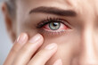 © Katerina Bond - Close-up of a woman's irritated blue eye showing redness, discomfort, and possible inflammation, with fingers gently touching the skin around the eye, highlighting a health or allergy issue.