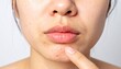 © SSuperTier - A close-up image of herpes on the lips, showing small clusters of blisters or sores, typically around the edge of the lips or corner of the mouth, symptoms of a herpes simplex virus.