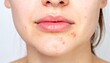 © SSuperTier - A close-up image of herpes on the lips, showing small clusters of blisters or sores, typically around the edge of the lips or corner of the mouth, symptoms of a herpes simplex virus.