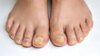 © anissaikat - Yellow toenails fungal infection feet closeup