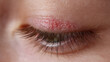 © Marut - Red irritated skin on upper eyelid shows eczema flareup with visible inflammation and dryness on close up of closed eye