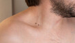 © Nathalie Tabak - close up of a man's neck with two small similar birthmarks on the skin, dermatology, skin examination, skin conditions, health