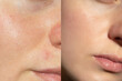 © Vikto - Macro comparison of facial pores before and after skincare treatment, showing smoother and clearer complexion, ideal for dermatology and beauty concept.